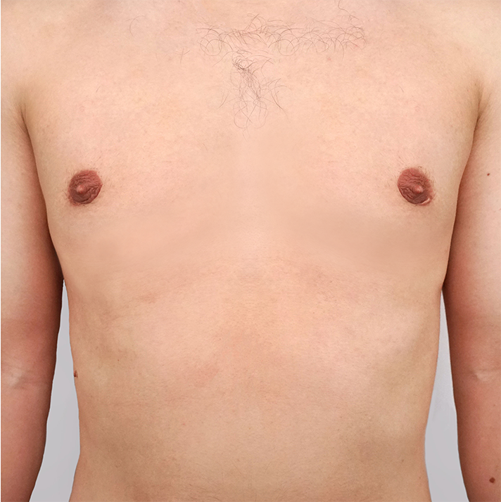 AFTER FLAT CHEST