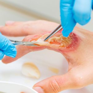 Burn Reconstruction