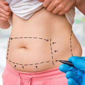 Liposuction